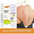 stretch marks removal cream